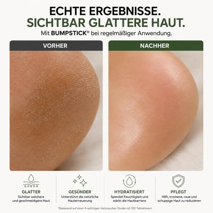 BUMPSTICK® Glykolsäure Peeling Stick
